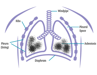 Asbestosis - Scarring occurs and results in respiratory problems