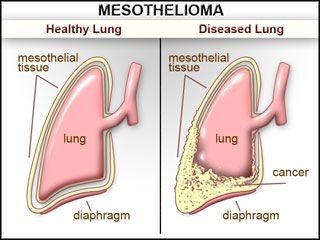 Mesothelioma simplified - lung with mesothelioma 