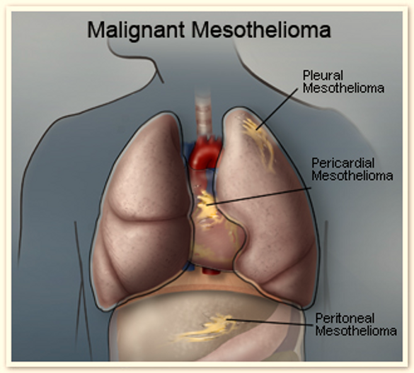 Mesothelioma Statistics: Occurrence in the body