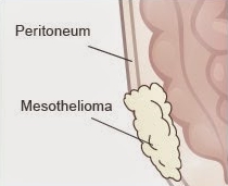 Peritoneal Mesothelioma 