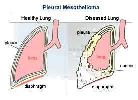 Pleural Mesothelioma Explained - Pleural Mesothelioma 