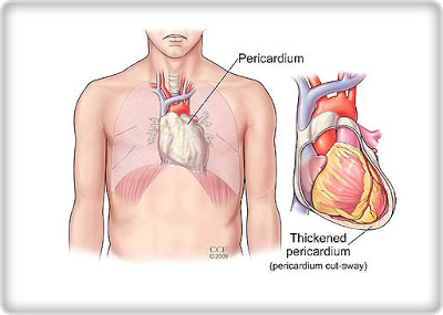 Pericardial Mesothelioma - Thickened pericardium