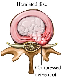 Disc Herniation V. Bulging Disc - Normal disc Disc Herniation V. Bulging Disc - Normal disc