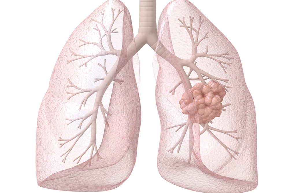 What Blood Work Indicates Colon Cancer